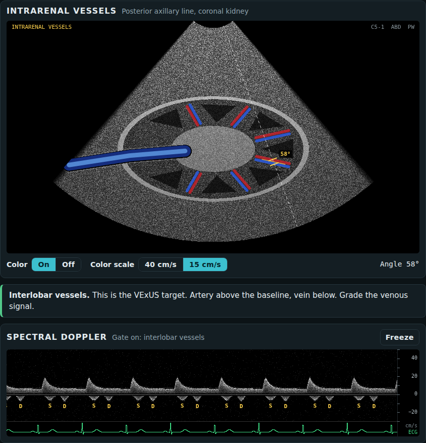 Acquire mode: a generated kidney image with color Doppler, the Doppler gate on an interlobar vessel, and the artery and vein trace it records